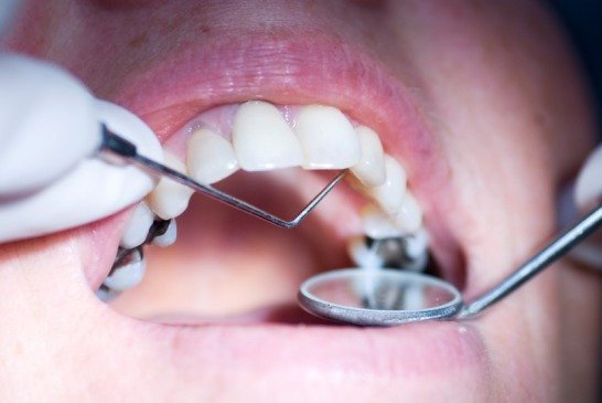 xxxxxxxxxxxxxxxdental_fillings.jpg